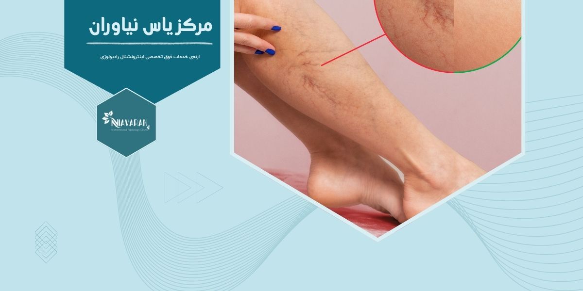 RFA واریس چیست و در تهران کجا انجام می شود؟ RFA واریس چیست و در تهران کجا انجام می شود؟