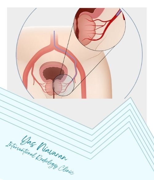 علائم بزرگی پروستات