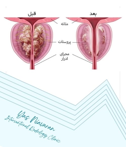 نتایج درمان پروستات با آنژیوگرافی