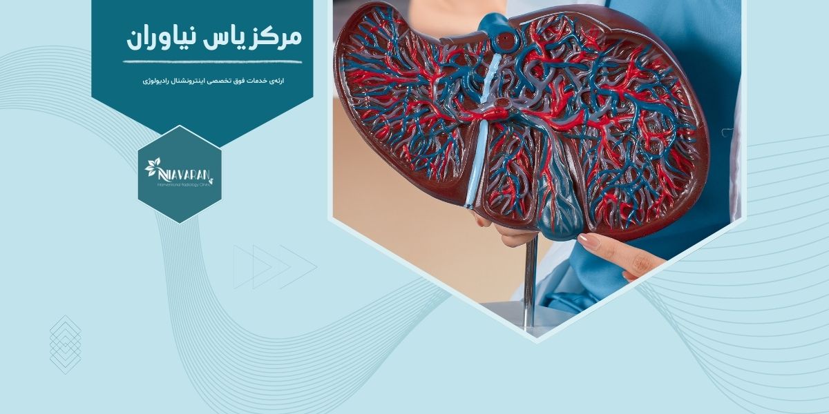 آنژیوآمبولیزاسیون تومورهای کبدی چیست و در تهران کجا انجام می شود؟ آنژیوآمبولیزاسیون تومورهای کبدی چیست و در تهران کجا انجام می شود؟