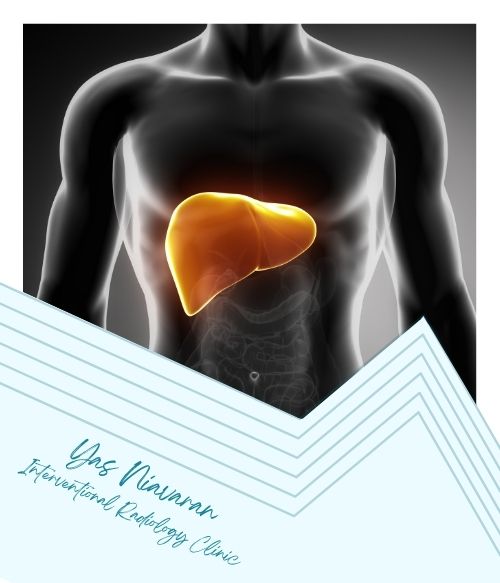 هزینه آنژیوآمبولیزاسیون چقدر است؟ هزینه آنژیوآمبولیزاسیون چقدر است؟