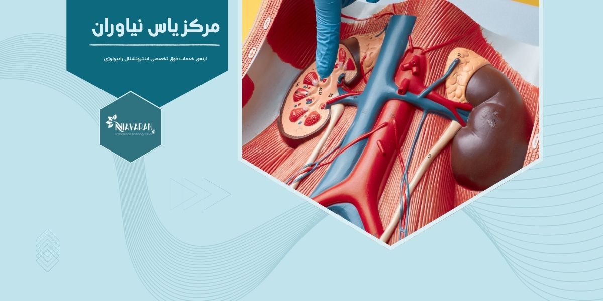 چه کسانی کاندید مناسب برای درمان بامایکروویو کلیه هستند؟ چه کسانی کاندید مناسب برای درمان بامایکروویو کلیه هستند؟