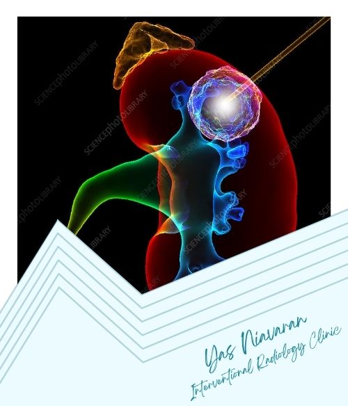 کاربردهای مایکروویو آتروترمی کاربردهای مایکروویو آتروترمی