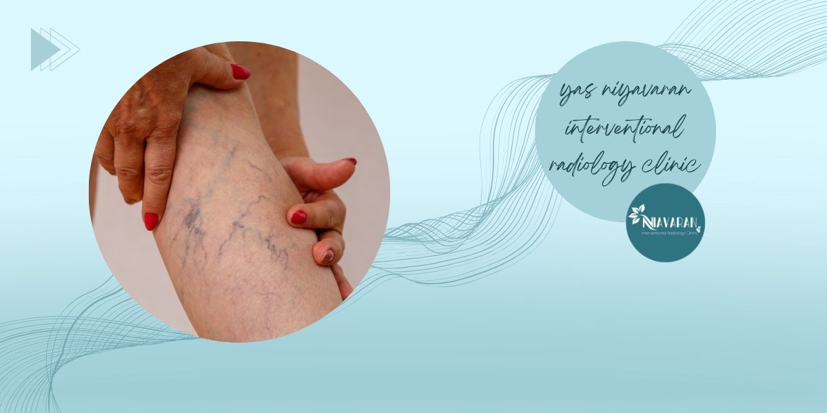 علائم واریس علائم واریس