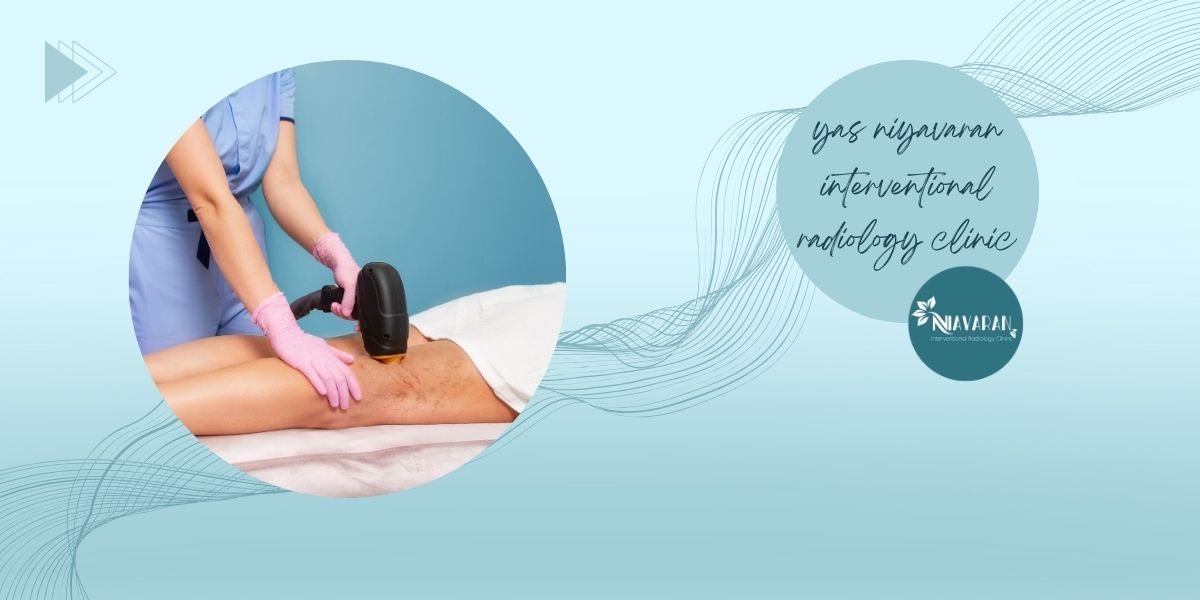 عوارض واریس عوارض واریس