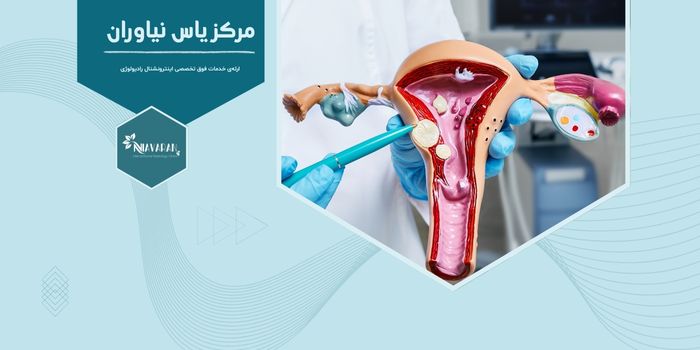 آنژیو آمبولیزاسیون فیبروم رحم چیست و در تهران کجا انجام می‌شود؟