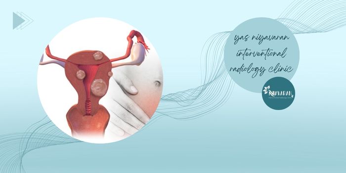 مزایای آنژیوآمبولیزاسیون رحم