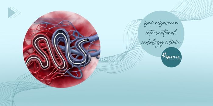 روند انجام آمبولیزاسیون فیبروم رحم