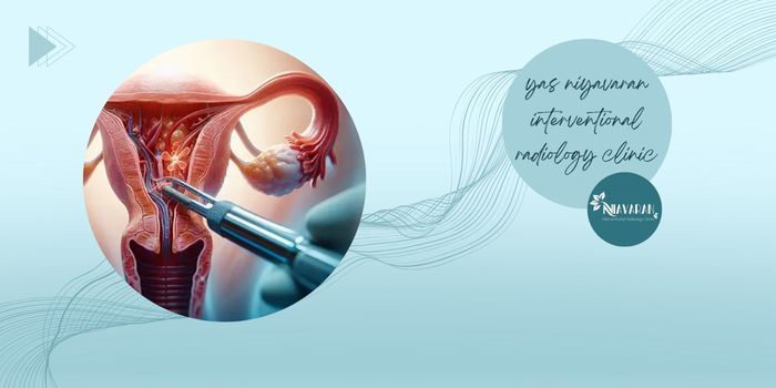 تاثیر آمبولیزاسیون فیبروم رحم در باروری