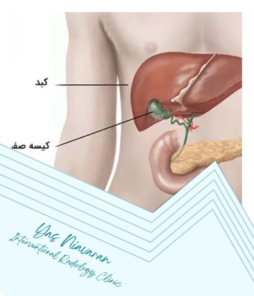 عوارض و خطرات احتمالی استنت‌گذاری