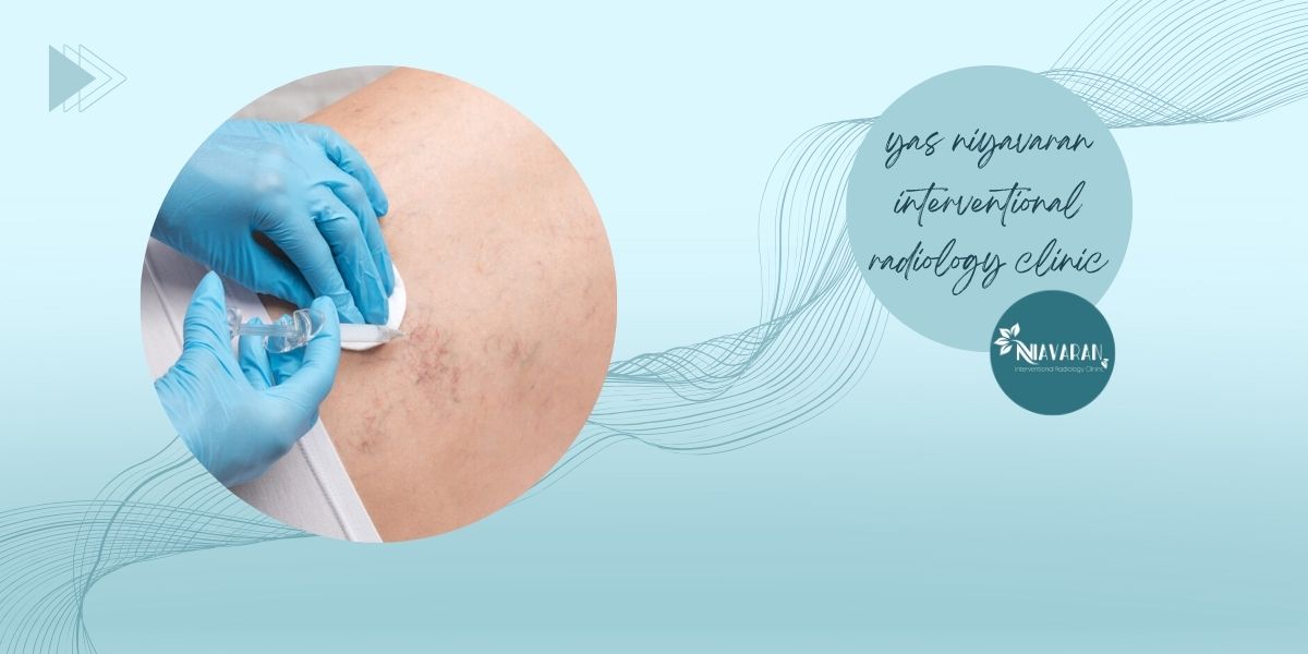 بعد اسکلروتراپی چند ساعت نباید راه رفت؟