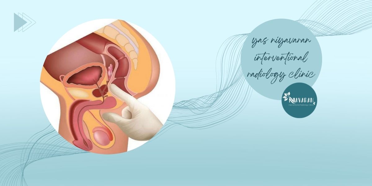 BPH چگونه تشخیص داده می شود؟