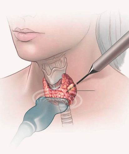 تشخیص و درمان غیرجراحی توده‌های تیروئید