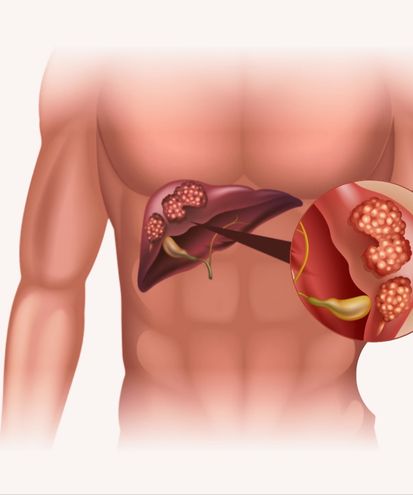 تشخیص و درمان غیرجراحی تودههای کبدی تشخیص و درمان غیرجراحی تودههای کبدی