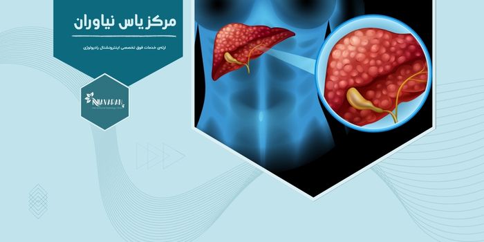 آزمایش‌های دقیق برای تشخیص کبد چرب غیرالکلی