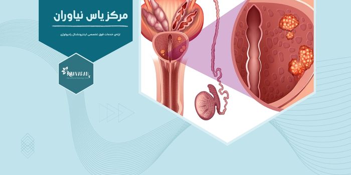 آیا برای تشخیص سرطان پروستات باید نمونه‌ برداری انجام شود؟