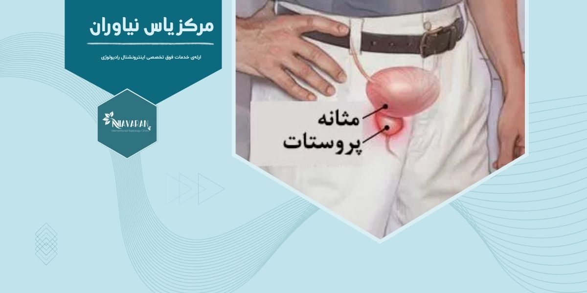 آیا بزرگ شدن پروستات نشانه سرطان است؟ آنچه باید بدانید