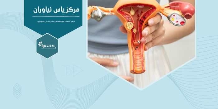 آیا درمان غیرجراحی برای فیبروم‌های رحمی تاثیر دارد؟