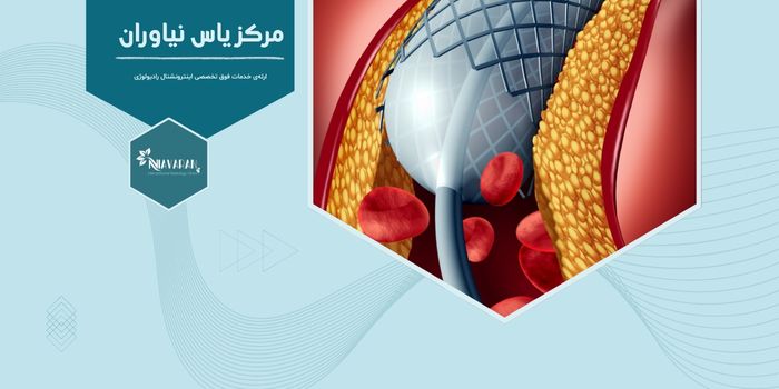 استنت گذاری صفرا چیست و در تهران کجا انجام می شود؟