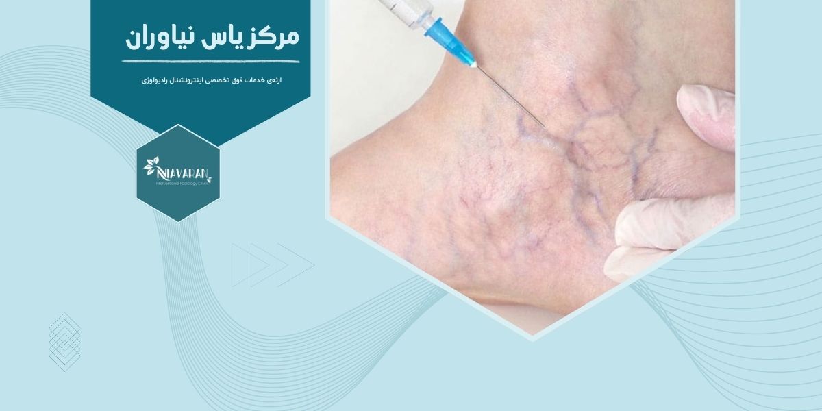 اسکلروتراپی واریس چیست و در تهران کجا انجام می شود؟ اسکلروتراپی واریس چیست و در تهران کجا انجام می شود؟