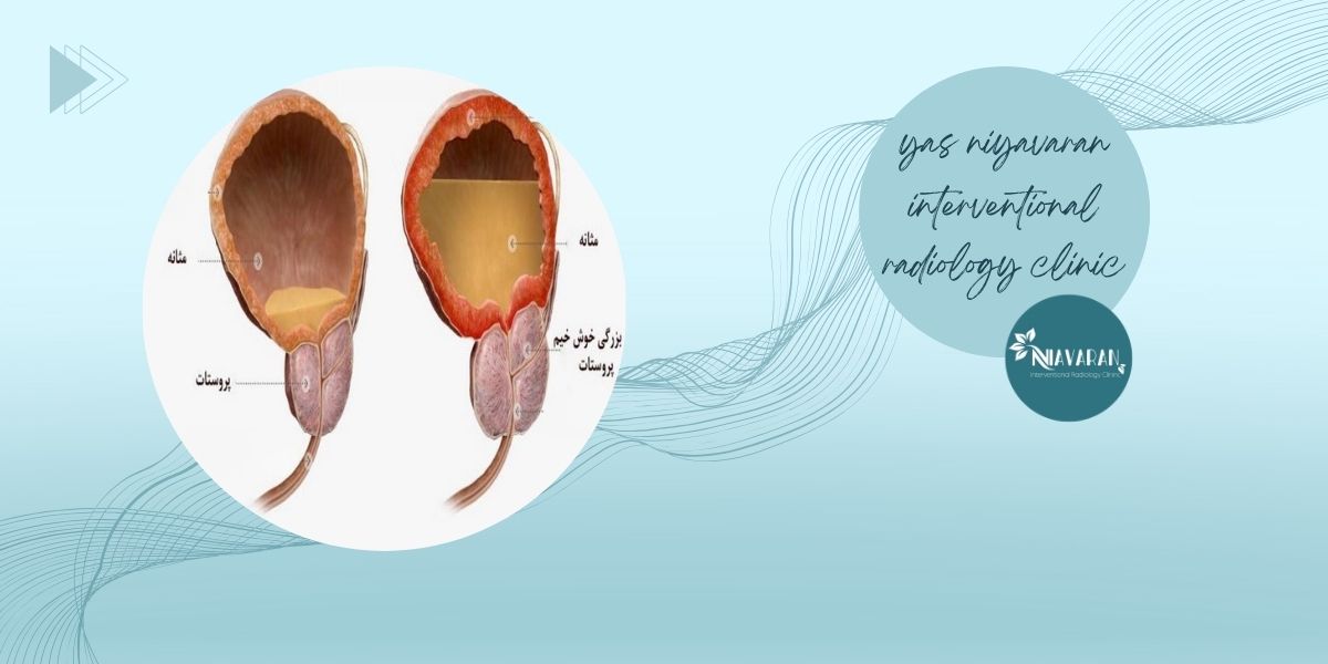 علائم بزرگ شدن پروستات
