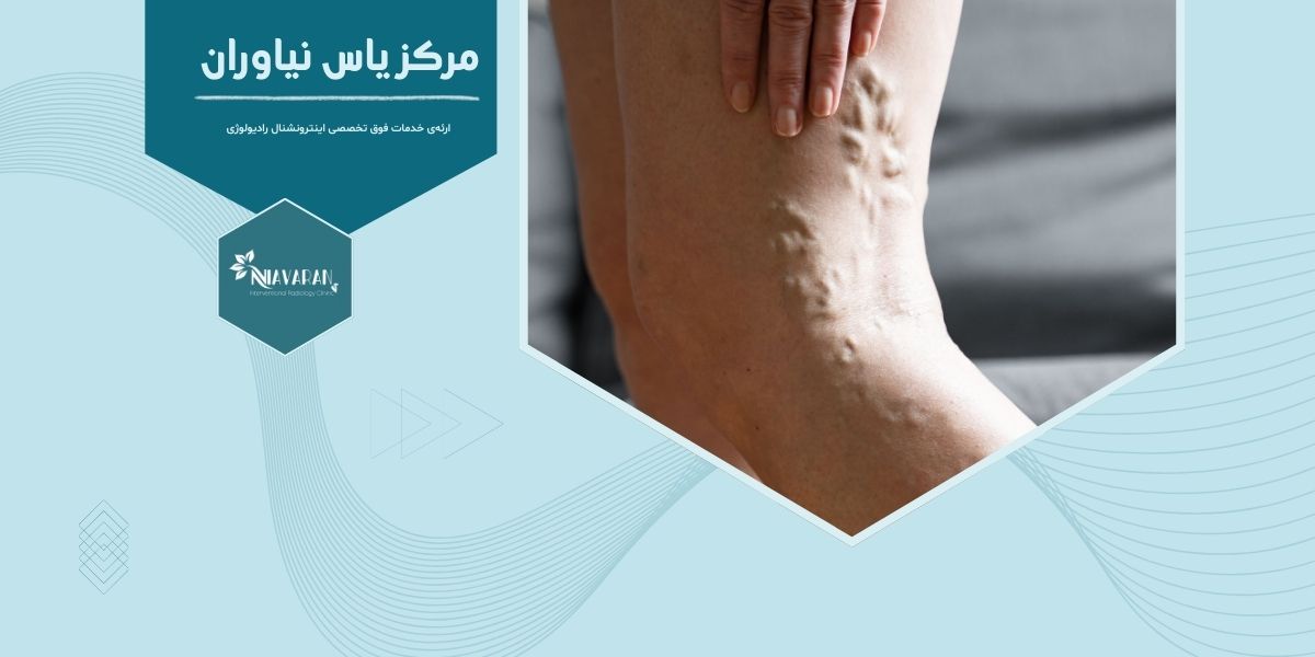 بهترین کلینیک درمان واریس در شمال تهران بهترین کلینیک درمان واریس در شمال تهران