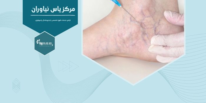 تا چند ساعت بعد از اسکلروتراپی نباید پیاده‌روی کرد؟