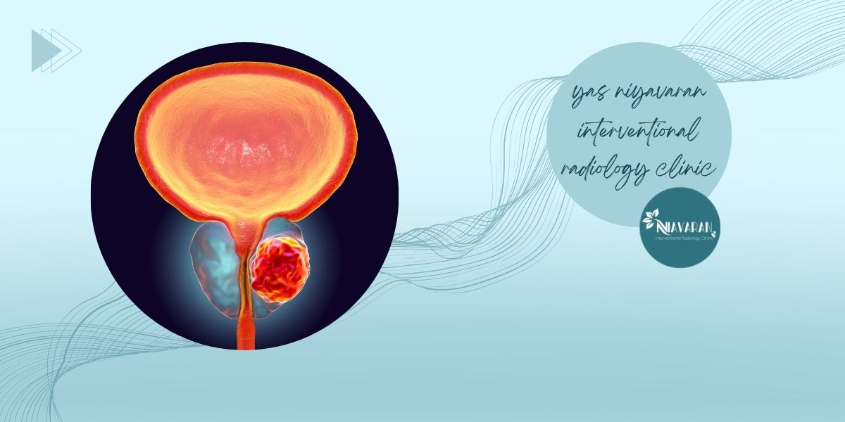 جایگزین‌های بیوپسی پروستات  