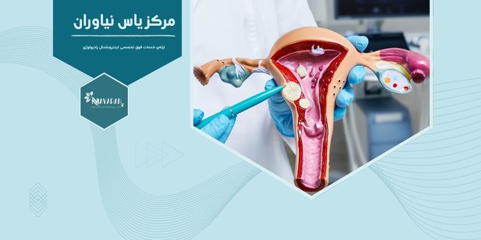جدیدترین و بهترین راه درمان پولیپ رحم چیست و چگونه انجام می شود؟