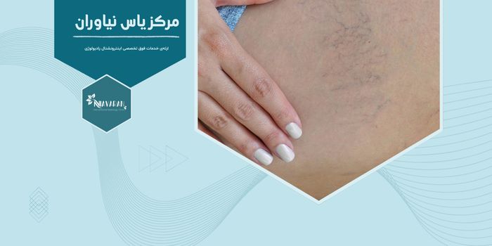 رگ‌های قرمز روی ران پا نشانه چیست و آیا قابل درمان است؟ 