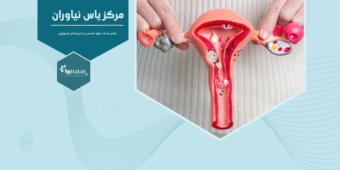 عوارض آمبولیزاسیون شریان رحمی و هر آنچه باید بدانید