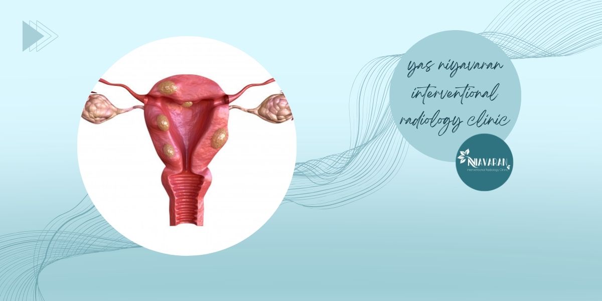 عوامل کاهش اندازه میوم رحمی