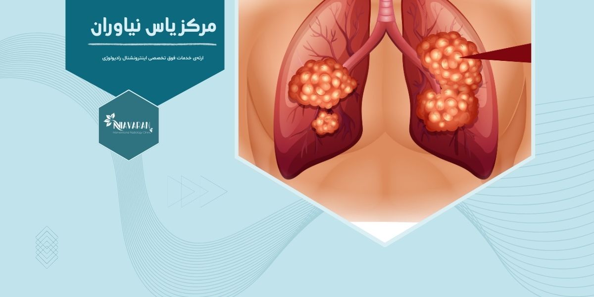 مایکروویو ریه چه درمانی است و در تهران کجا انجام می شود؟ مایکروویو ریه چه درمانی است و در تهران کجا انجام می شود؟