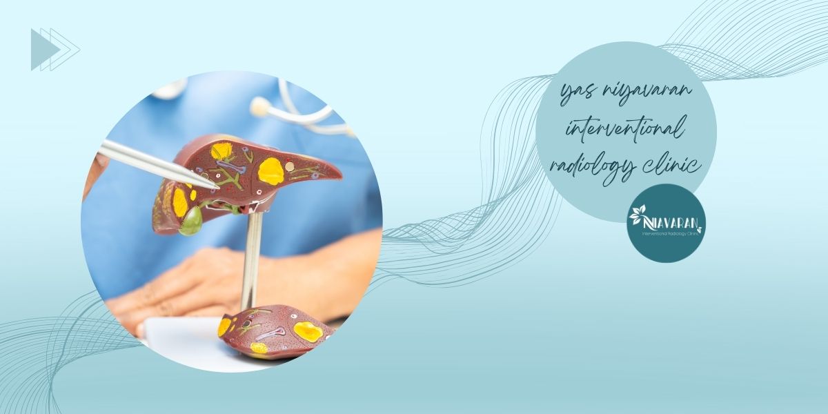 مزایای آنژیوآمبولیزاسیون مزایای آنژیوآمبولیزاسیون