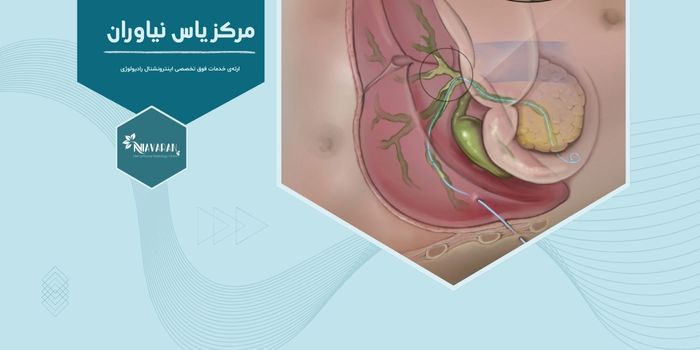 چرا استنت‌گذاری صفرا در بیماران مبتلا به سرطان اهمیت دارد؟