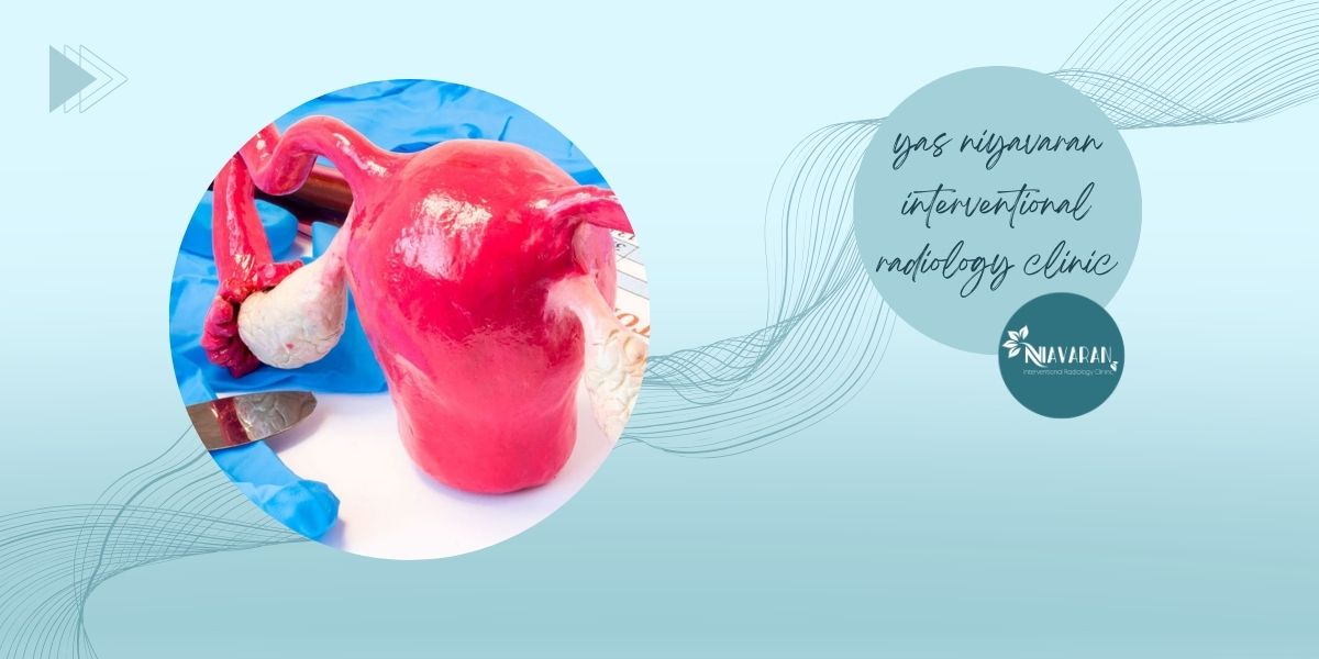 چه زمانی فیبروم رحم نیاز به درمان دارد؟