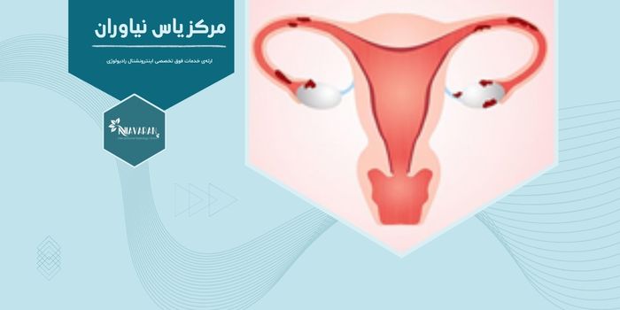 چگونه آندومتریوز و آندومتریوما را با درمان‌های جدید درمان کنیم؟