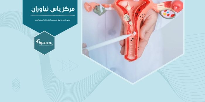 چه علائمی نشان میدهد فیبروم در حال بزرگ شدن است؟ چه علائمی نشان میدهد فیبروم در حال بزرگ شدن است؟