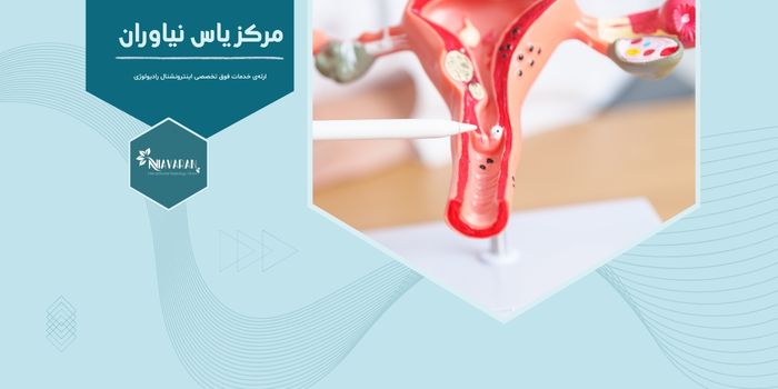 آیا فیبروم رحم خود به‌ خود از بین می‌رود؟