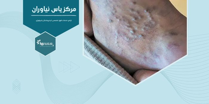 آیا واریس درمان نشده می تواند خطرناک باشد؟ بررسی بهترین روش های درمان