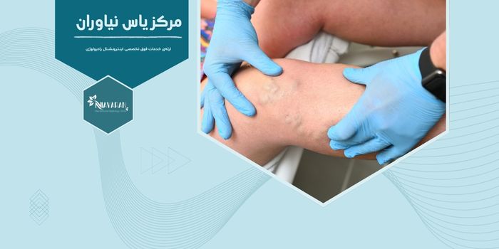 بعد از درمان واریس احتمال برگشت آن چقدر است؟ بعد از درمان واریس احتمال برگشت آن چقدر است؟