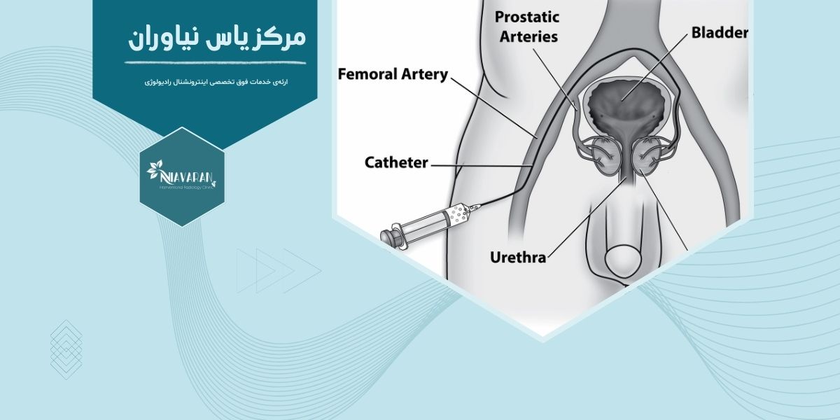 آیا نمونه‌برداری پروستات درد دارد؟ مقدار درد آن چقدر است؟ 